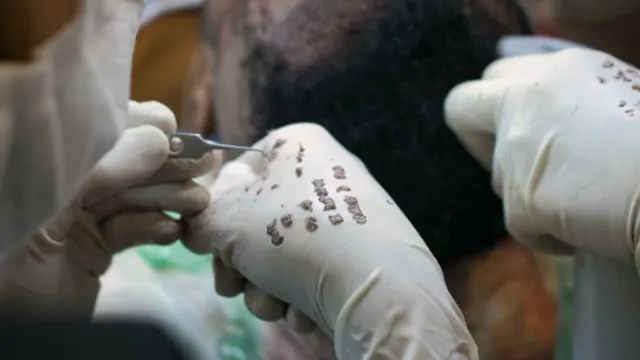 Beard Transplant