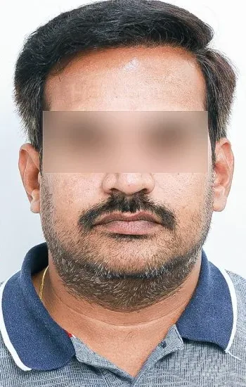 HairSense Hair Transplant Clinic, Navi Mumbai