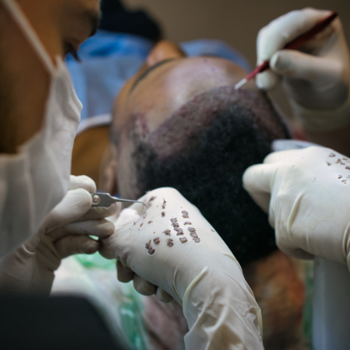 Facial Hair Transplant patient at HairSense Navi Mumbai
