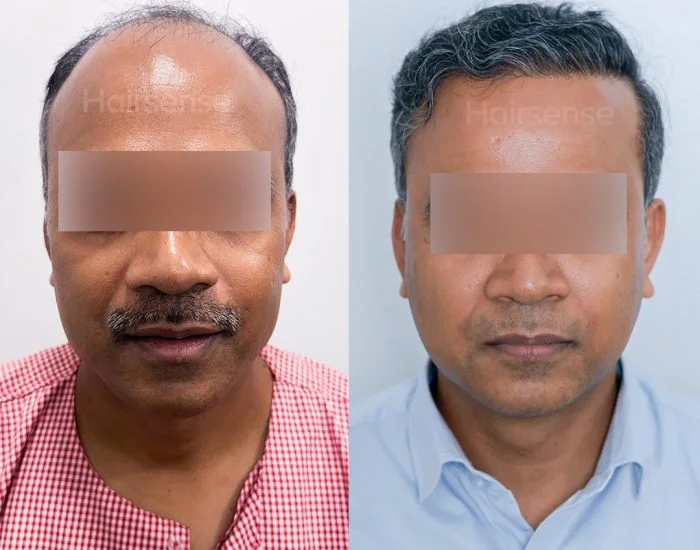 Hair transplant before and after