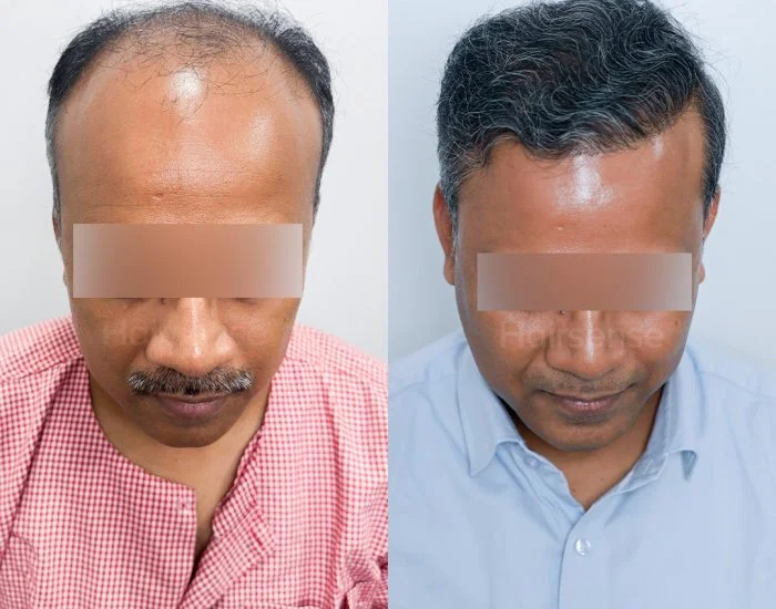 Hair transplant before and after