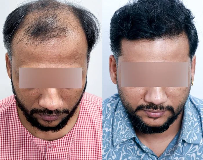Hair transplant before and after