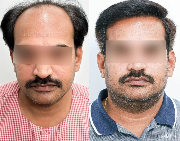 Hair transplant before and after