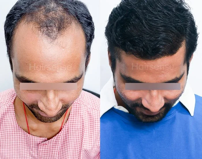 Hair transplant before and after