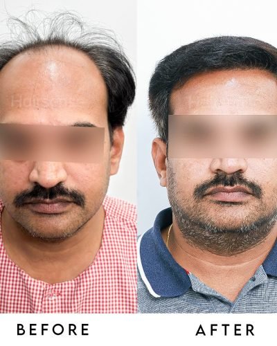 Confidence Restored. ✅From thinning to thriving. Swipe left to view the complete coverage and na