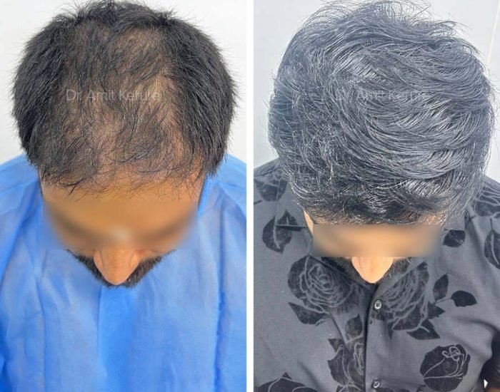 Hair Transplant Result - Dr Amit Kerure Skin And Hair Transplant Clinic Vashi Navi Mumbai 03