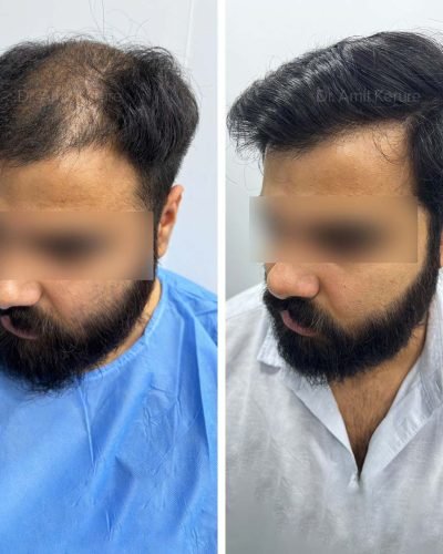 Hair Transplant Result - Dr Amit Kerure Skin And Hair Transplant Clinic Vashi Navi Mumbai 04