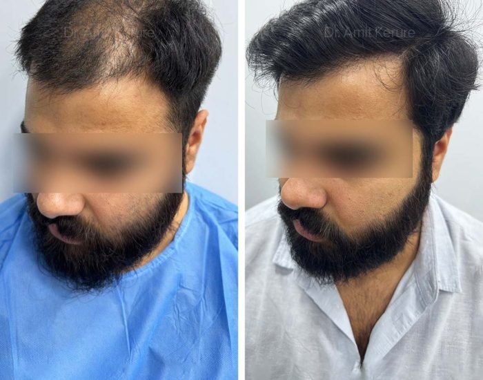 Hair Transplant Result - Dr Amit Kerure Skin And Hair Transplant Clinic Vashi Navi Mumbai 04