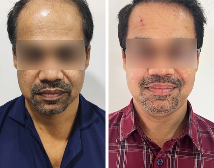 Hair Transplant Result - Dr Amit Kerure Skin And Hair Transplant Clinic Vashi Navi Mumbai 05