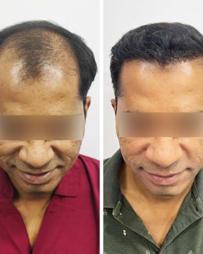 Hair Transplant Result - Dr Amit Kerure Skin And Hair Transplant Clinic Vashi Navi Mumbai 06