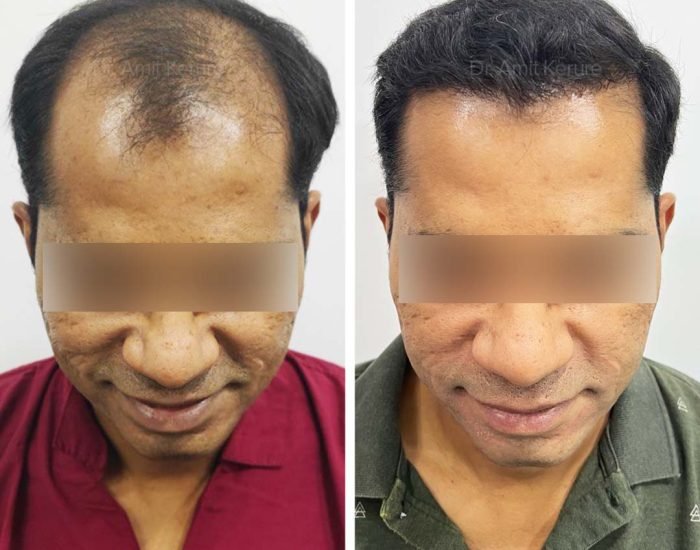 Hair Transplant Result - Dr Amit Kerure Skin And Hair Transplant Clinic Vashi Navi Mumbai 06