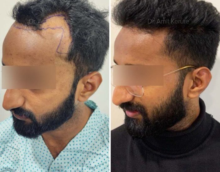 Hair Transplant Result - Dr Amit Kerure Skin And Hair Transplant Clinic Vashi Navi Mumbai 07
