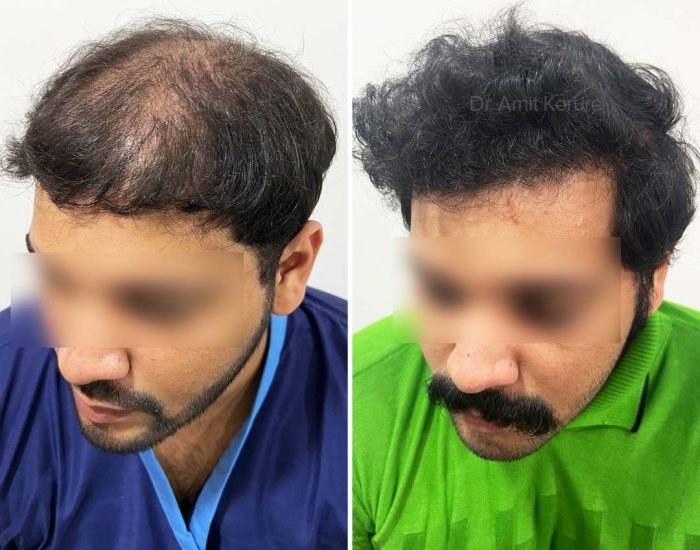 Hair Transplant Result - Dr Amit Kerure Skin And Hair Transplant Clinic Vashi Navi Mumbai 08