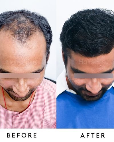 Your transformation starts with a single follicle. 🧬✨Thinning hair and a receding hairline can
