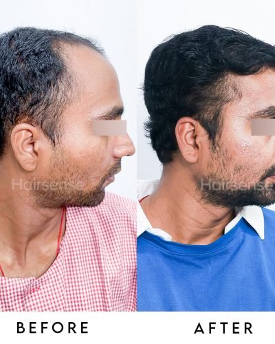 Your transformation starts with a single follicle. 🧬✨Thinning hair and a receding hairline can (1)