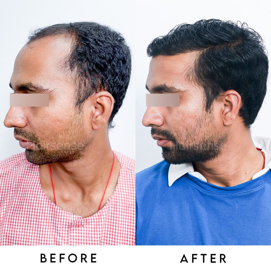 Instagram post from hairsense_hairtransplantclinic. This post is in position 5.