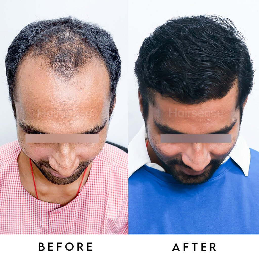 Instagram post from hairsense_hairtransplantclinic. This post is in position 1.