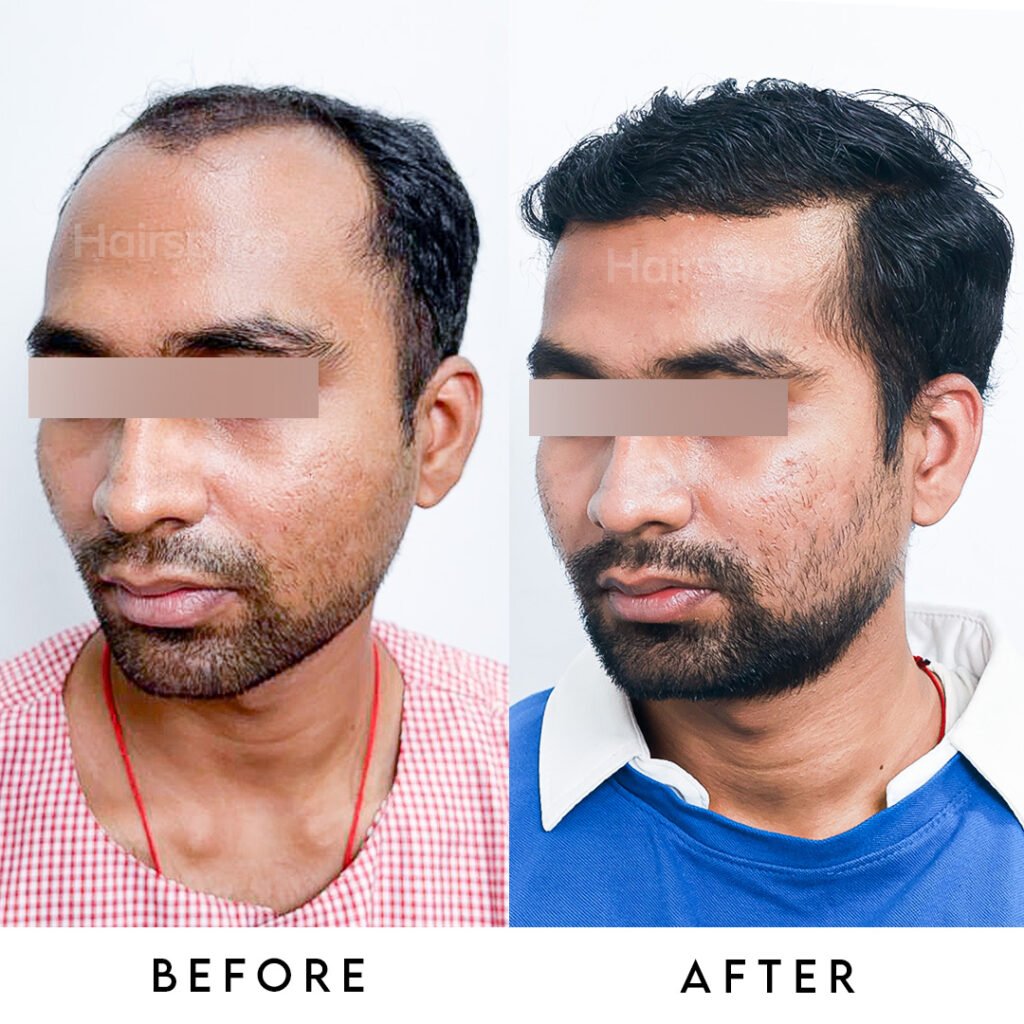 Instagram post from hairsense_hairtransplantclinic. This post is in position 4.