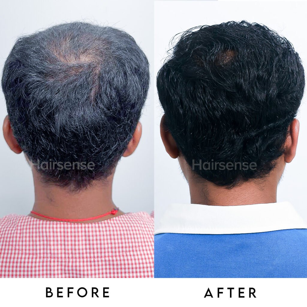 Instagram post from hairsense_hairtransplantclinic. This post is in position 6.