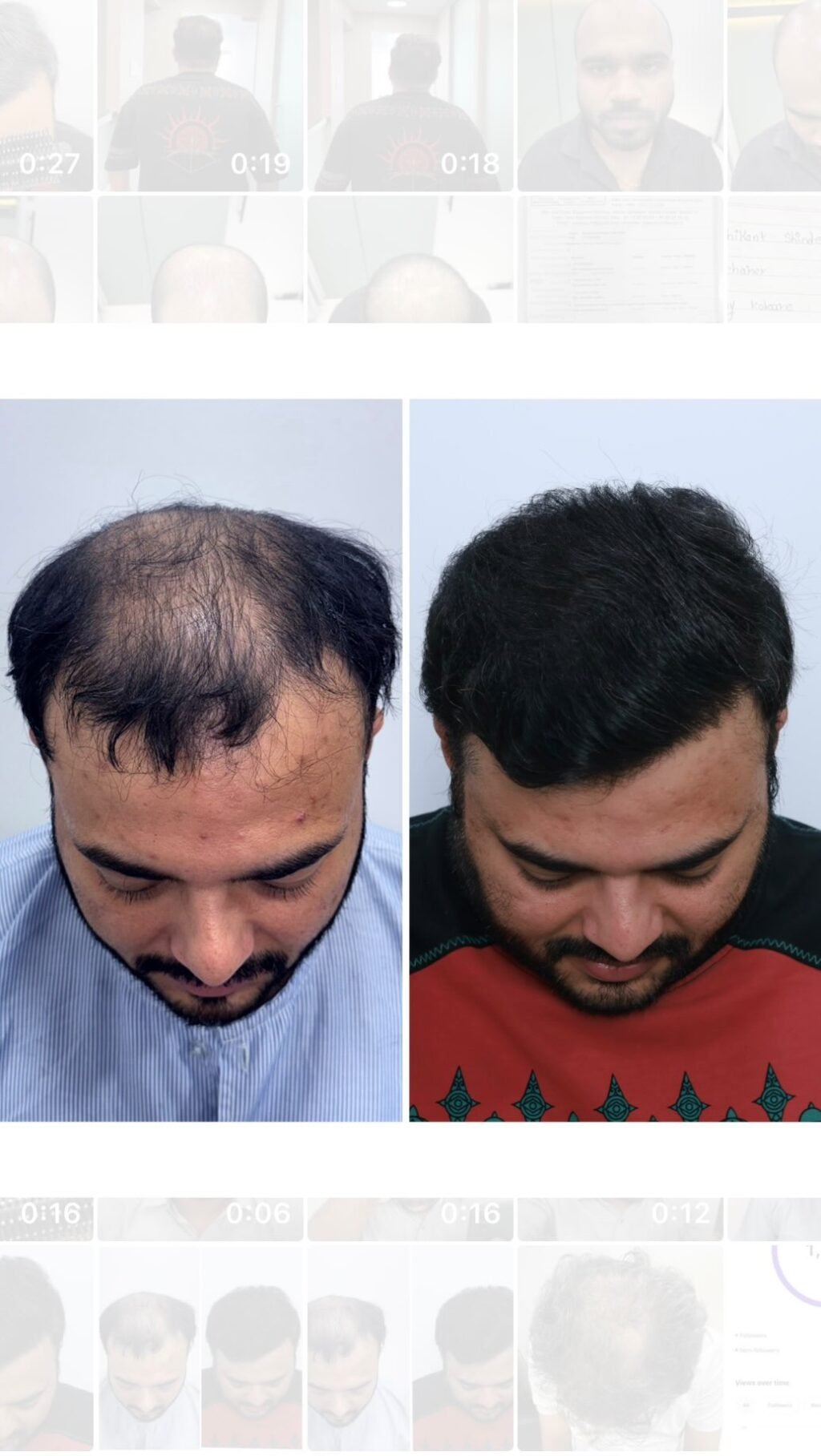 Instagram post from hairsense_hairtransplantclinic. This post is in position 6.