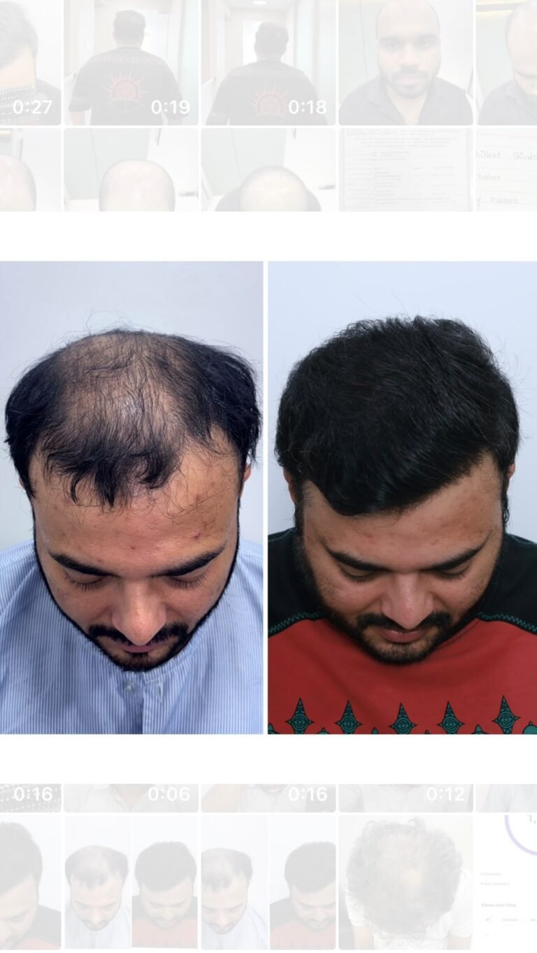 Instagram post from hairsense_hairtransplantclinic. This post is in position 7.