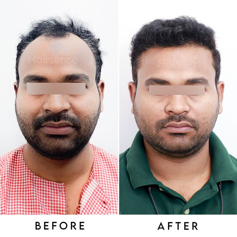 Instagram post from hairsense_hairtransplantclinic. This post is in position 2.