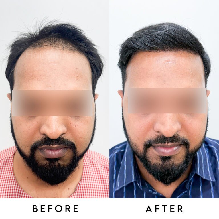 Instagram post from hairsense_hairtransplantclinic. This post is in position 1.