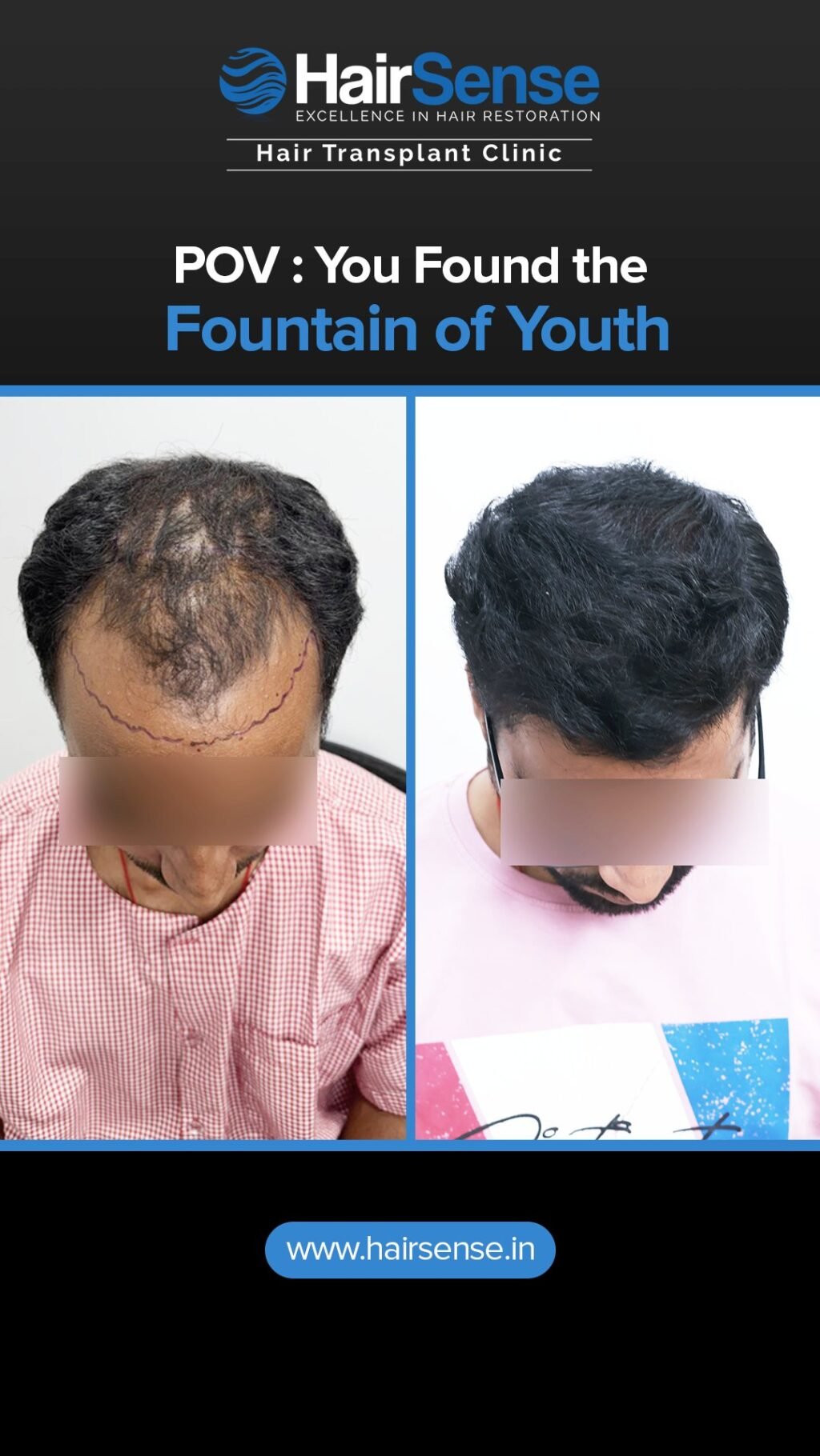 Instagram post from hairsense_hairtransplantclinic. This post is in position 2.