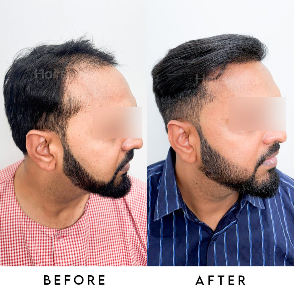 Instagram post from hairsense_hairtransplantclinic. This post is in position 2.