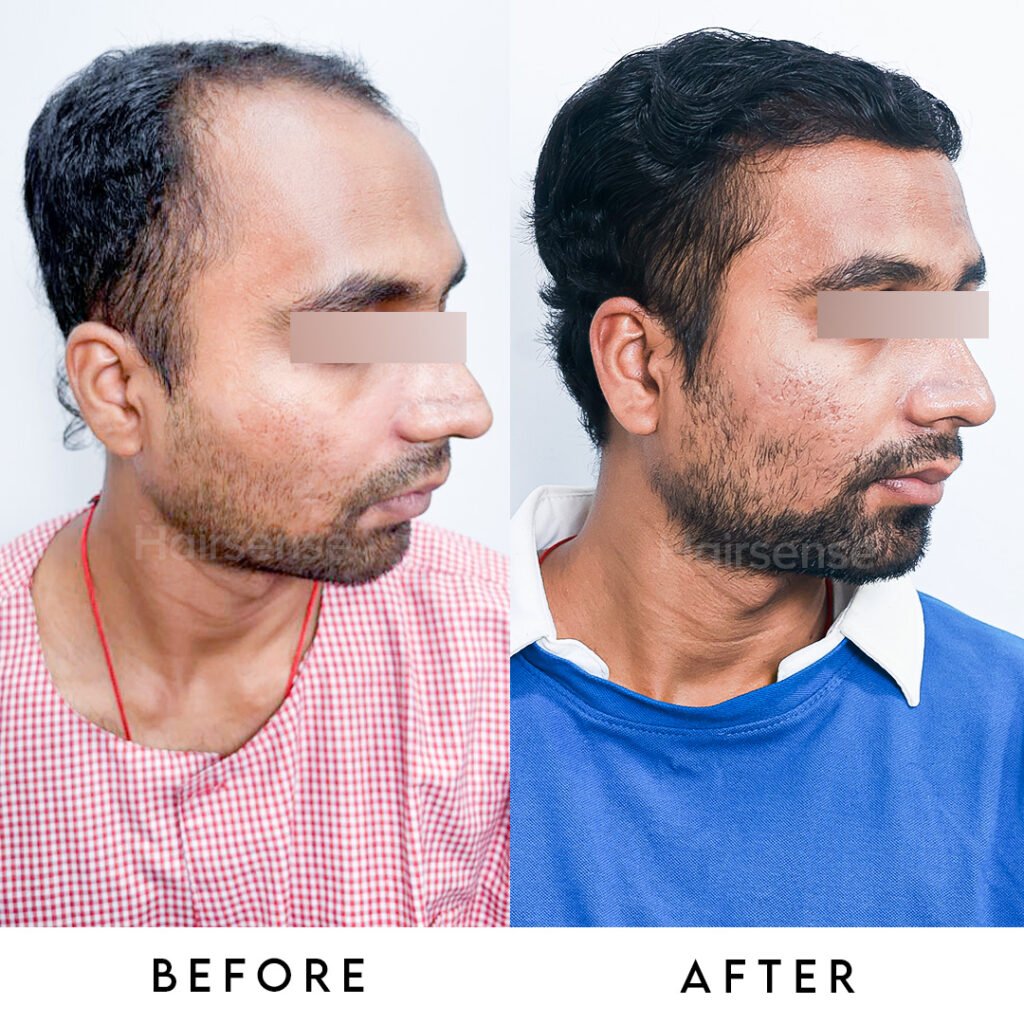 Instagram post from hairsense_hairtransplantclinic. This post is in position 2.