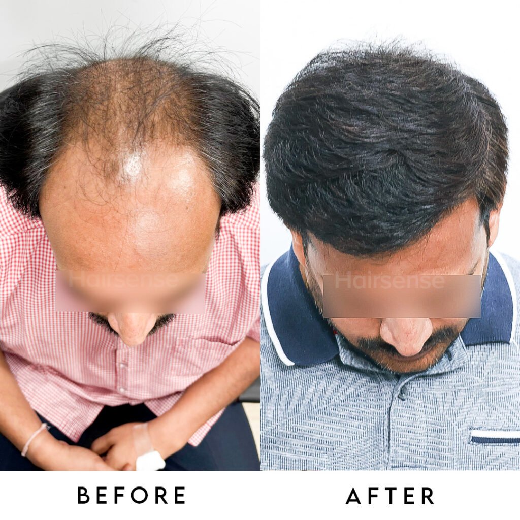 Instagram post from hairsense_hairtransplantclinic. This post is in position 3.