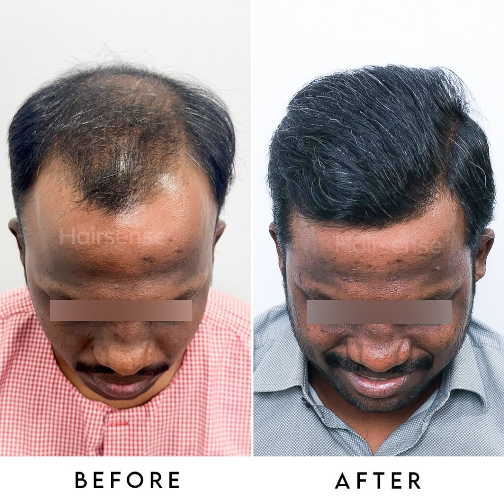 Instagram post from hairsense_hairtransplantclinic. This post is in position 0.