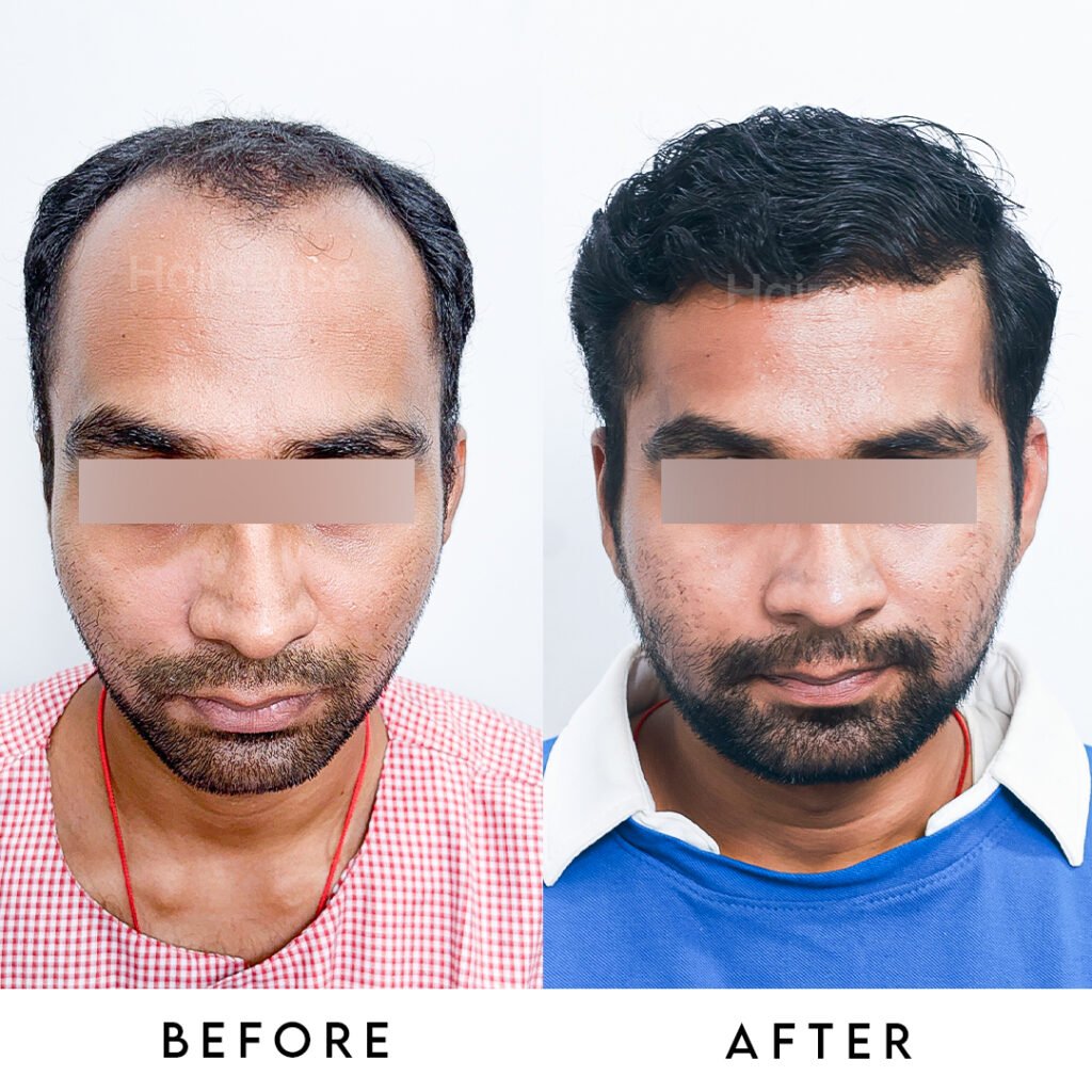 Instagram post from hairsense_hairtransplantclinic. This post is in position 0.