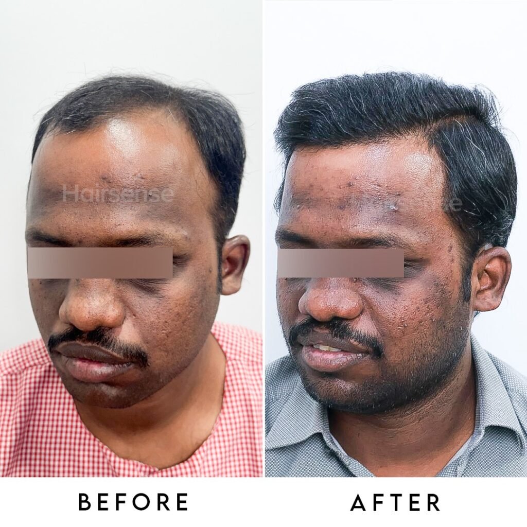 Instagram post from hairsense_hairtransplantclinic. This post is in position 1.