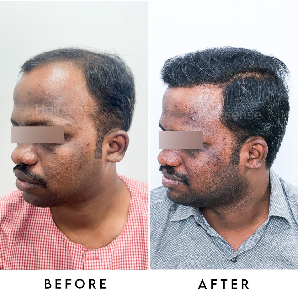 Instagram post from hairsense_hairtransplantclinic. This post is in position 2.