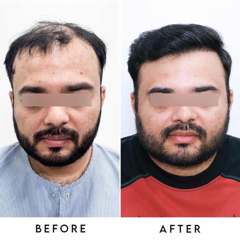 Instagram post from hairsense_hairtransplantclinic. This post is in position 7.