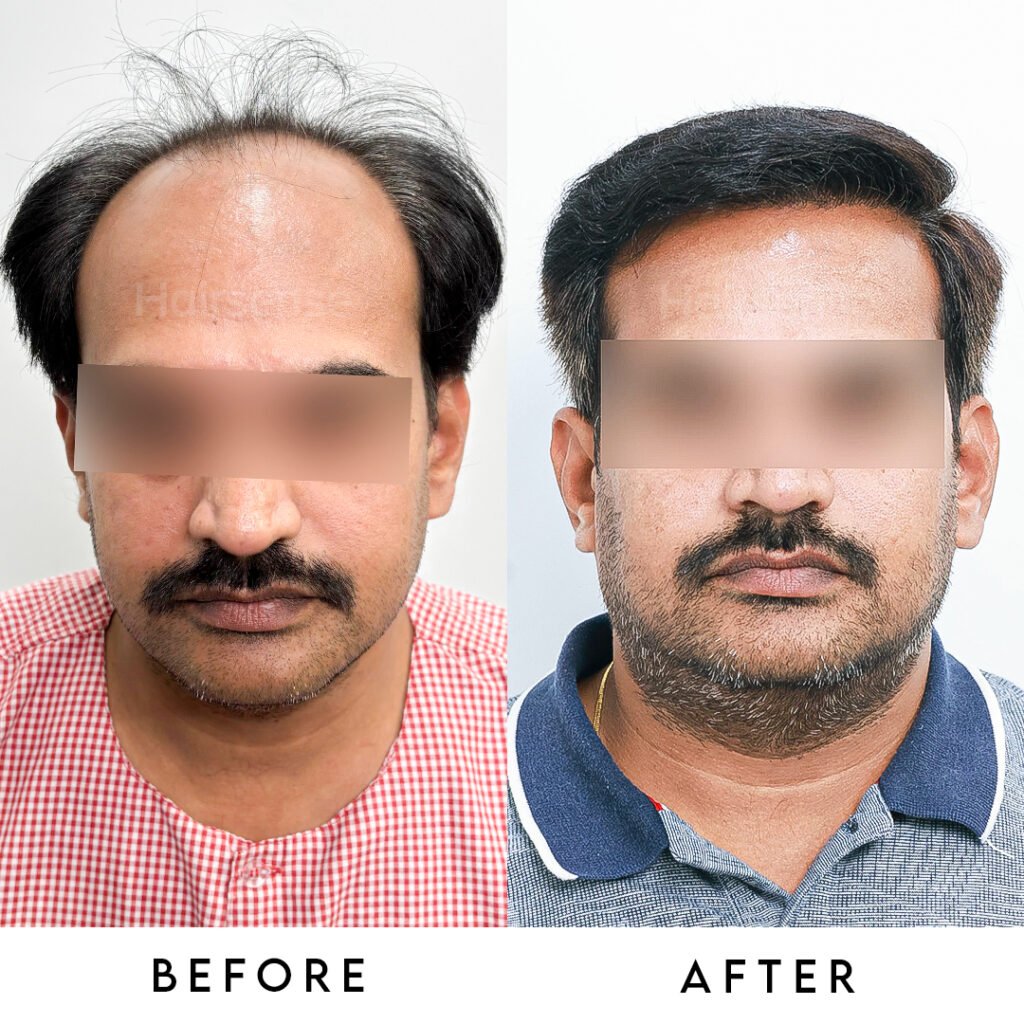 Instagram post from hairsense_hairtransplantclinic. This post is in position 0.