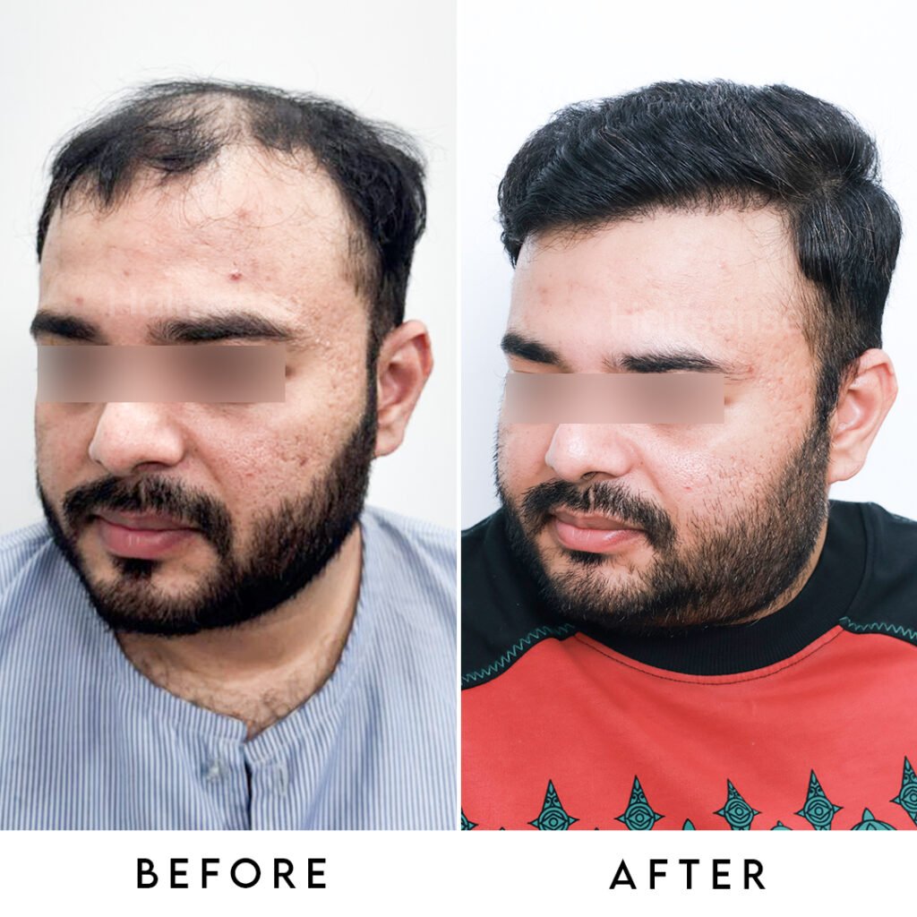 Instagram post from hairsense_hairtransplantclinic. This post is in position 4.