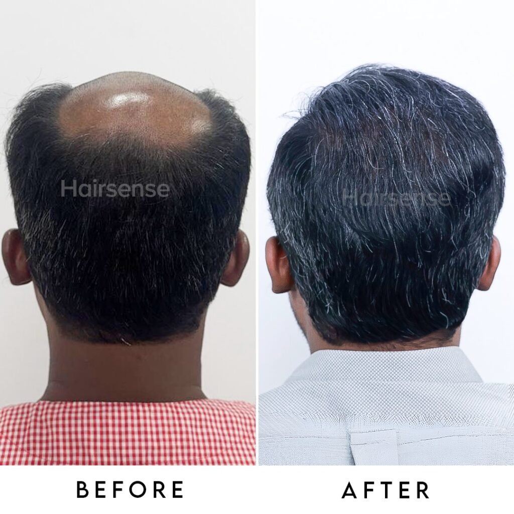 Instagram post from hairsense_hairtransplantclinic. This post is in position 5.