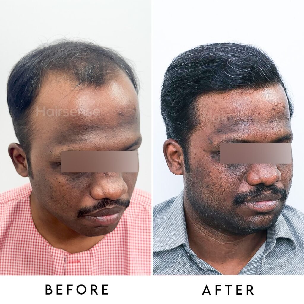 Instagram post from hairsense_hairtransplantclinic. This post is in position 3.