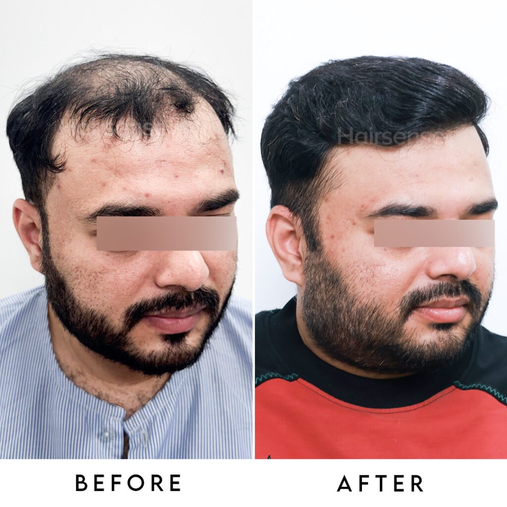 Instagram post from hairsense_hairtransplantclinic. This post is in position 2.