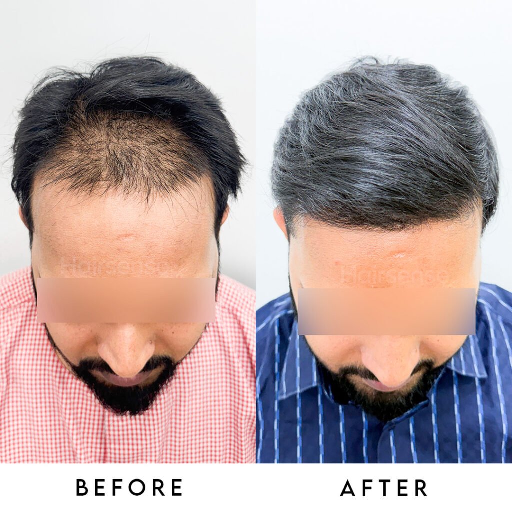 Instagram post from hairsense_hairtransplantclinic. This post is in position 5.