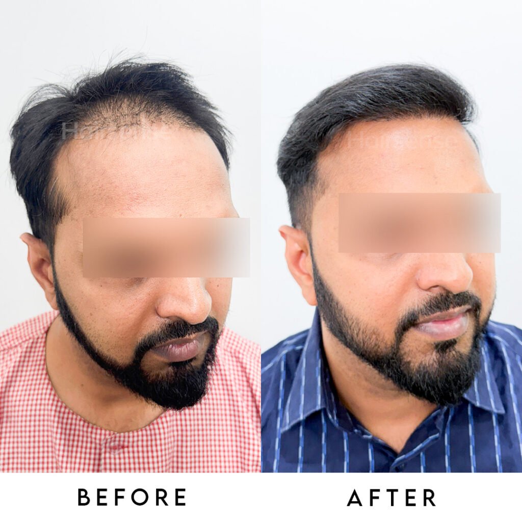 Instagram post from hairsense_hairtransplantclinic. This post is in position 1.