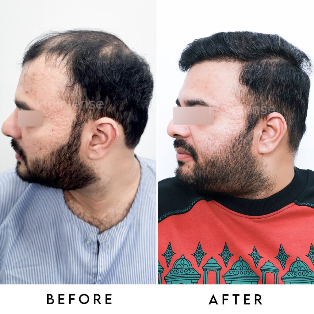 Instagram post from hairsense_hairtransplantclinic. This post is in position 5.