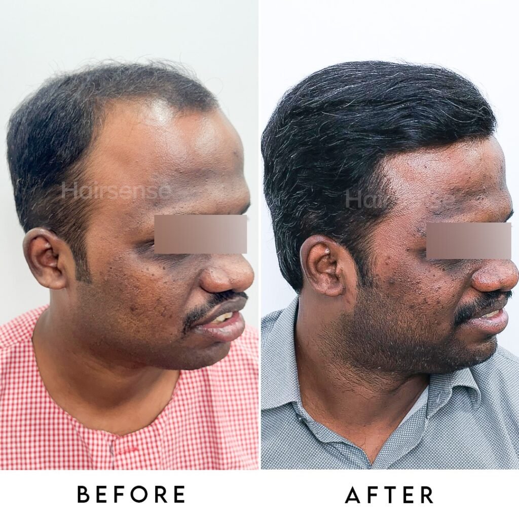 Instagram post from hairsense_hairtransplantclinic. This post is in position 4.