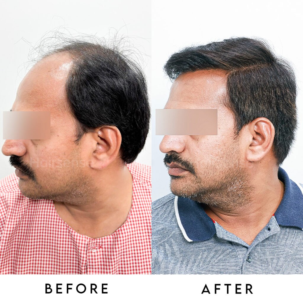 Instagram post from hairsense_hairtransplantclinic. This post is in position 1.