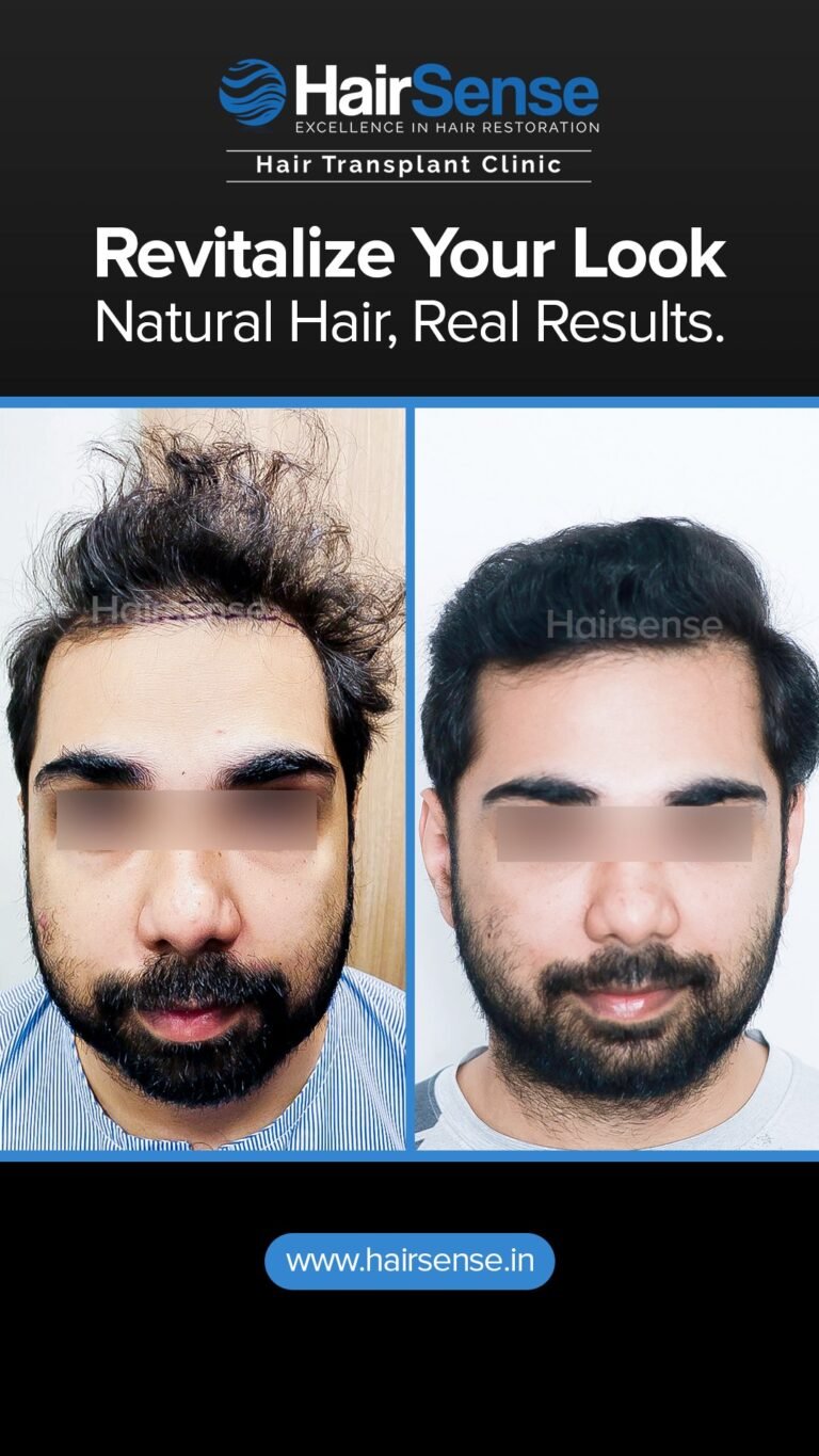 Instagram post from hairsense_hairtransplantclinic. This post is in position 3.