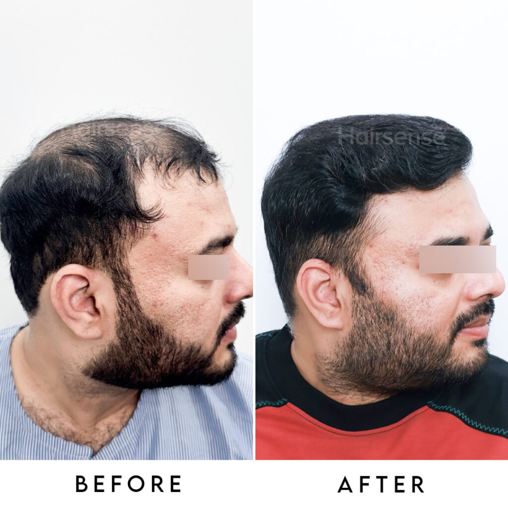 Instagram post from hairsense_hairtransplantclinic. This post is in position 3.