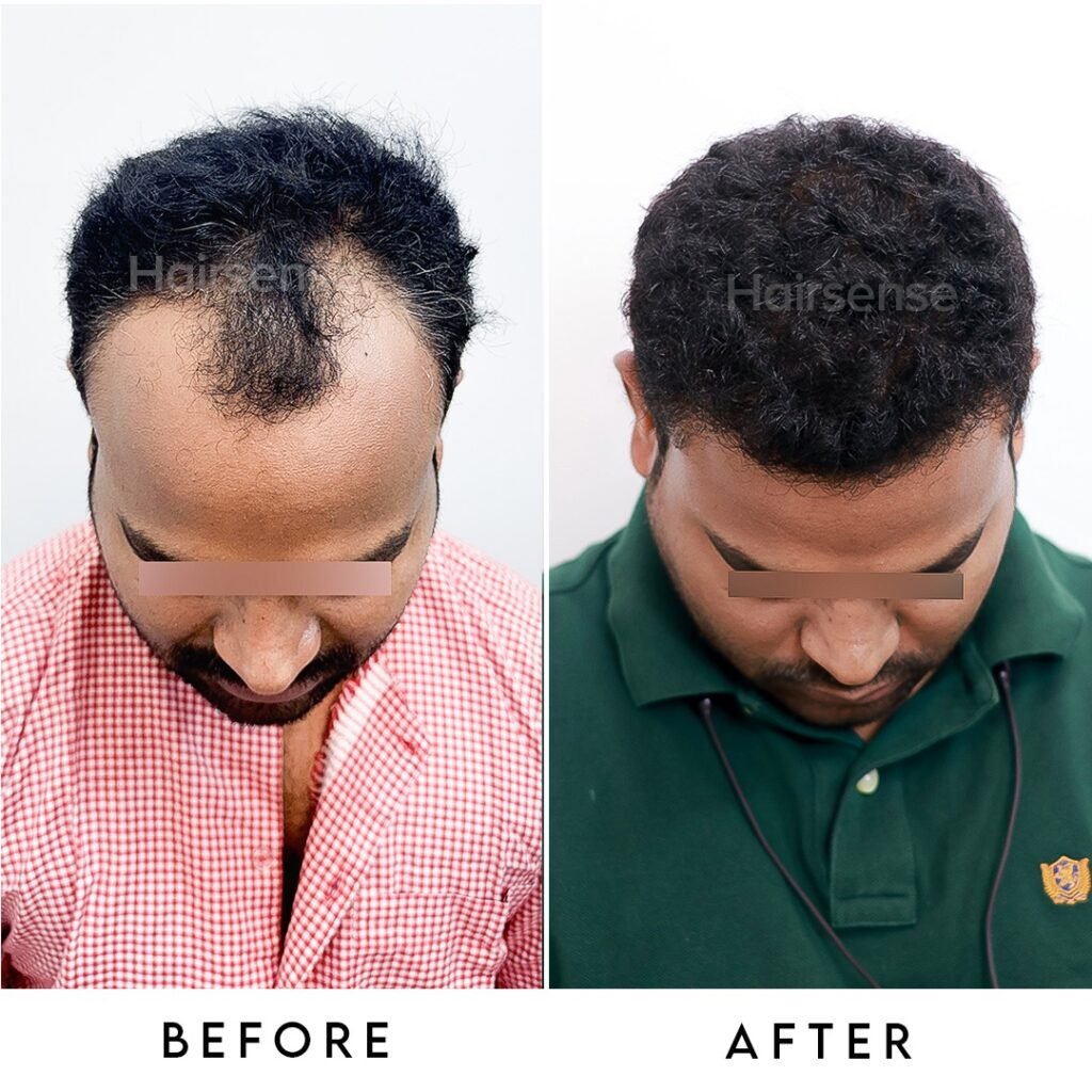 Instagram post from hairsense_hairtransplantclinic. This post is in position 2.