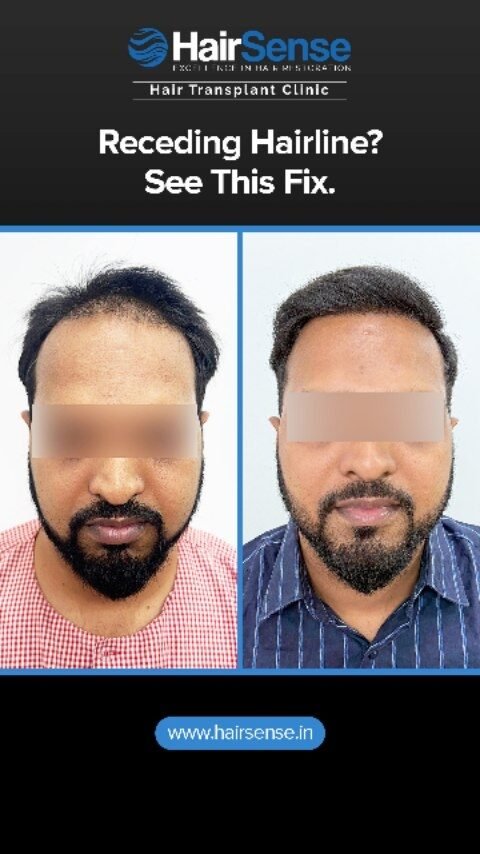 Instagram post from hairsense_hairtransplantclinic. This post is in position 5.